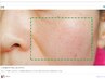 しみ、しわ、ハリ、気になる毛穴にフォトで効果実感