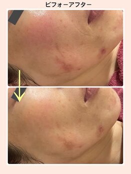 リファイン(REFINE)/もっとお肌を綺麗にしたい！