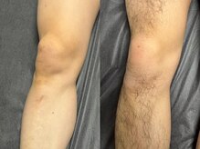 ボス 桑名店(BOSS)/足脱毛(before&after)