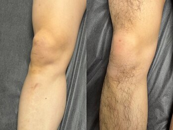 ボス 桑名店(BOSS)/足脱毛(before&after)