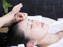 ハチハチ(808)/痛みの少ない優しい美容鍼