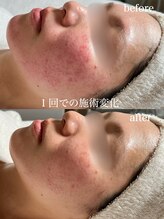 ルラシェ(Relacher)/ポレーション導入