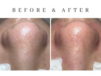 ルシェリア(Le cherien)/ハイドラ×ピーリング