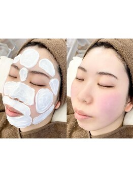 顔脱毛がしたい