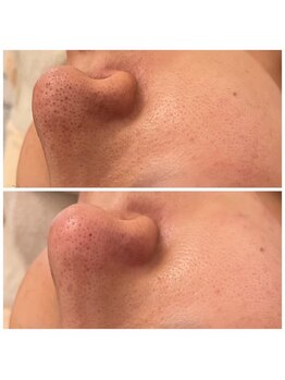 メゾンリュバン 梅田店(Maison Ruban)/毛穴洗浄・美白フォト|毛穴ケア