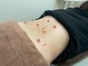 【腰痛・足のだるさでお悩みの方に】局所鍼灸30分