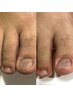 【キャンペーン価格/男性フット】即日バレずに深爪矯正