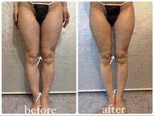 ビノスビューティー(vinos.beauty)/症例写真　下半身痩身1回