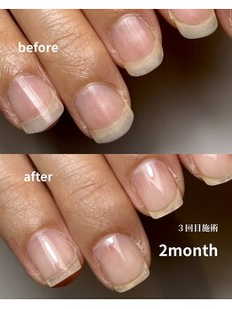 ロイヤル ビューティー サロン(Royal Beauty Saloon)/2か月の変化　自爪育成