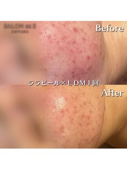 サロン ド エス アオヤマ(SALON DE S AOYAMA)/ララピール＆LDM（ニキビ赤み）