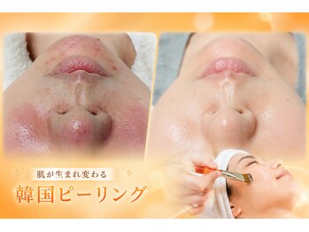 アオイ(Aoi)の写真/【ララピール】韓国アイドル級のハリつや肌☆毛穴やニキビ、ほうれい線にも効果◎
