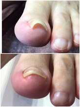 モアクリスタル(More Crystal)/巻き爪補正