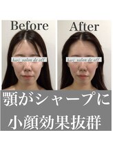 ハリサロンドオフ 心斎橋店(hari salon de off)/小顔効果抜群♪