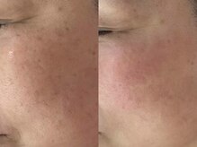 サクラ(SAKURA)/本厚木/フェイシャル/シミ