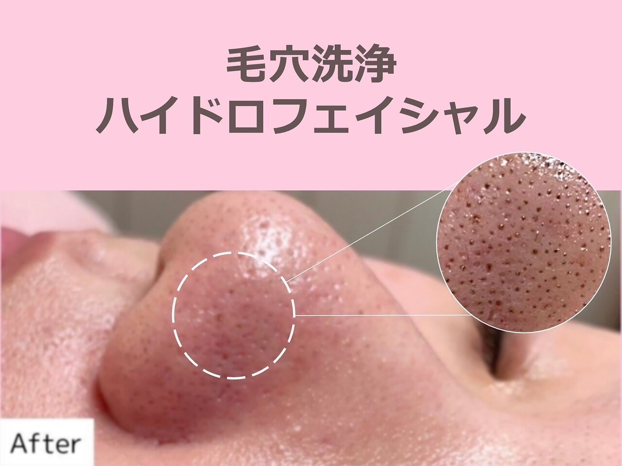 岸和田市でピーリングが人気のエステサロン｜ホットペッパービューティー