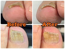 町田市巻き爪センター/1回目の施術