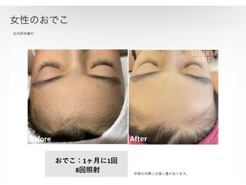 リネ(Rine)/before→after