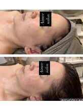 エイミー(Aimee)/【小顔コース】ビフォーアフター