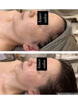 エイミー(Aimee)/【小顔コース】ビフォーアフター