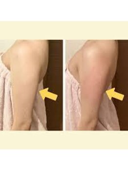 ラウレア(Laule'A)/最新痩身ボディ×レモンボトル