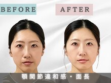 エルシンメトリー矯正院(ailesシンメトリー矯正院)/面長ビフォーアフター