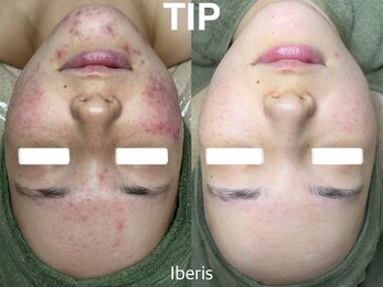 アリス(Alice)の写真/繰り返すニキビ・肌荒れに。肌状態を見極めて、一人ひとりに合った集中ケアをご提案