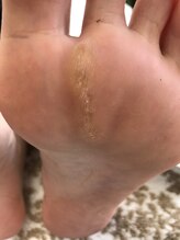 足のケア アンド 巻き爪 エムズ 白金通り店(M's)/角質トータルケア