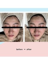 ロア ネイル アンド(loa nail and ...)/美肌質改善+小顔