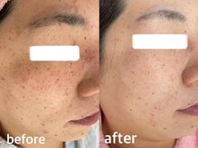 サクラ(SAKURA)/本厚木/フェイシャル/シミ