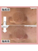 シェリー(Cherie)/＼１回でこの変化！！／