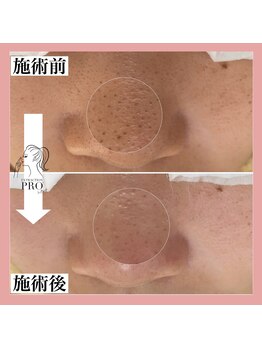 シェリー(Cherie)/＼１回でこの変化！！／