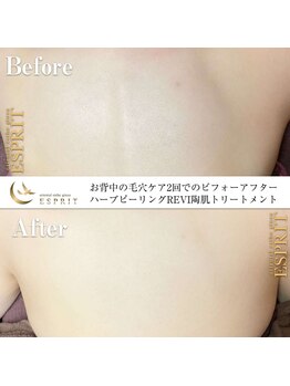 エスプリ 銀座店/ハーブピーリング背中銀座