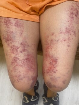 コル コルエ(koru korue)/脚が浮腫むのは血管が詰まってる