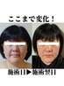 口内法＋小顔矯正＋美容小顔矯正　12,000円→4,400円　90分