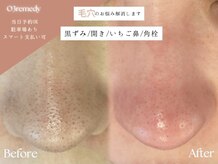 オゾンレメディ(O3remedy)