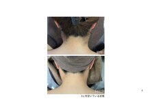 ミース 自由が丘店/うなじ矯正◆ビフォーアフター