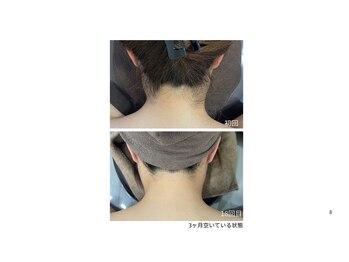 ミース 自由が丘店/うなじ矯正◆ビフォーアフター