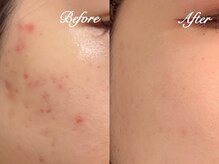 ティンクル(TWINKLE)の雰囲気（碧ハーブピーリングとダブルハーブピーリングのコンビネーション）