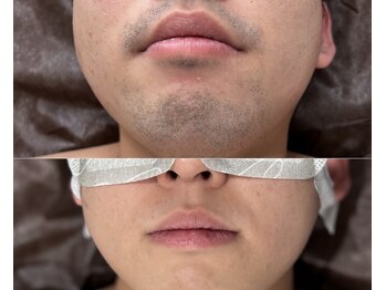 エイトブロウ 名古屋店(8BROW)の写真/名古屋でヒゲ脱毛ならBOSS｜青ヒゲ・毎日の髭剃りをラク