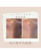 ビューティーサロン エー(A)/ハーブピーリング