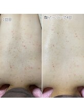 おうちサロン ミキ/背中などボディのピーリング人気