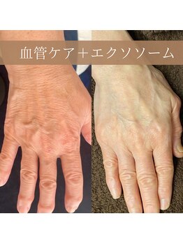 サンポ 神戸元町店(SANPO)/血管ケア×エクソソーム