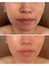 ルルドフォンテ(rurudo fonte.)/口元のたるみケアがスゴイ！