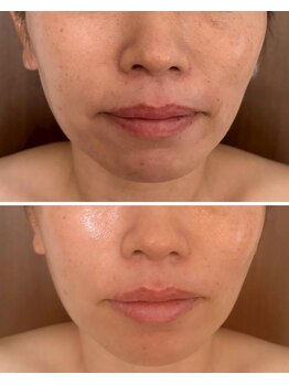 ルルドフォンテ(rurudo fonte.)/口元のたるみケアがスゴイ!