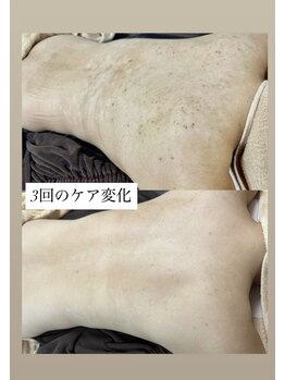 スキンプローズ(skinprose)/背中ハーブピーリング・ハード