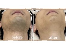 オーシャンスパ(Ocean Spa)/メンズ顔脱毛