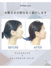 ボディケアルーム リフレキュア 中野(REFLECURE)/横顔・Eラインの変化