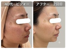 オリーブ(Olive)/気付いたらシミ？美容液導入増。