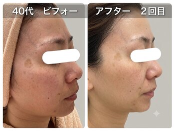 オリーブ(Olive)/気付いたらシミ?美容液導入増。