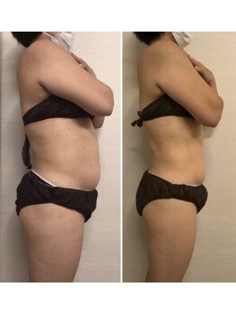 ジュメル 恵比寿店(Jumelles)/ぽっこりお腹ケア(´艸｀*)